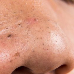 How to Get Rid of Blackheads Naturally — The Coffee Scrub That Changed My Skin