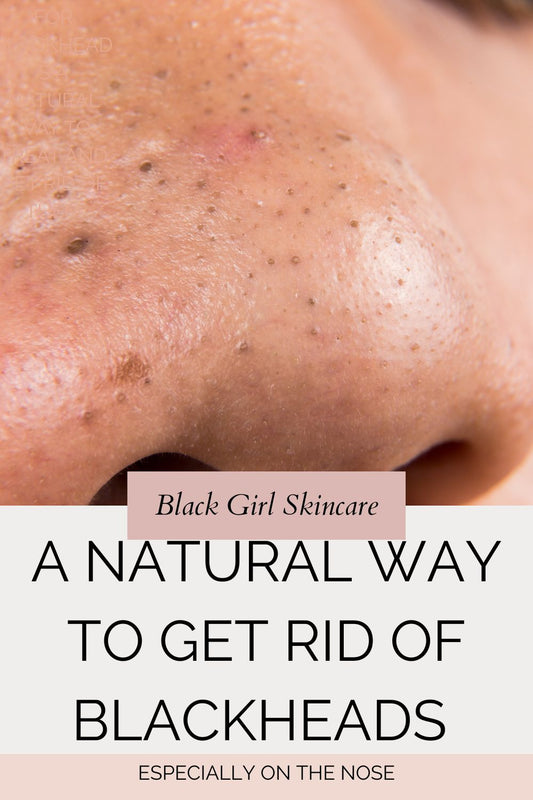 Skincare for Blackheads: A Natural Way to Treat and Get Rid of Them