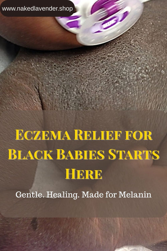Eczema on Black Babies: Why It Shows Up Differently—And What Actually Helps