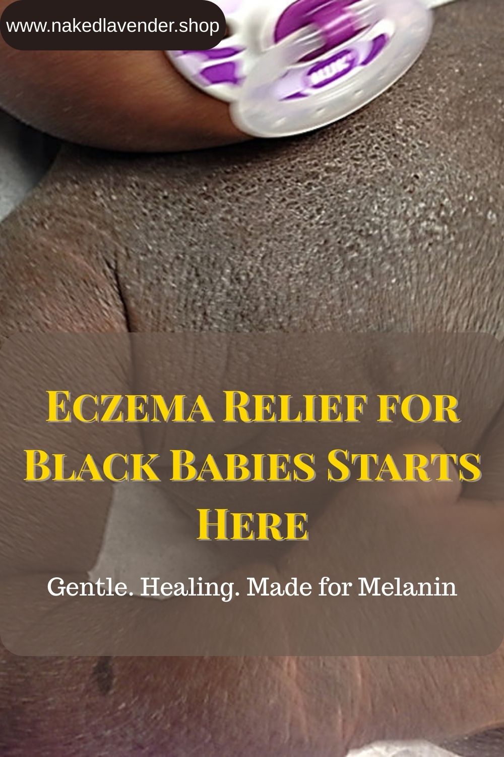 The Truth About Baby Eczema No One Tells Black Moms
