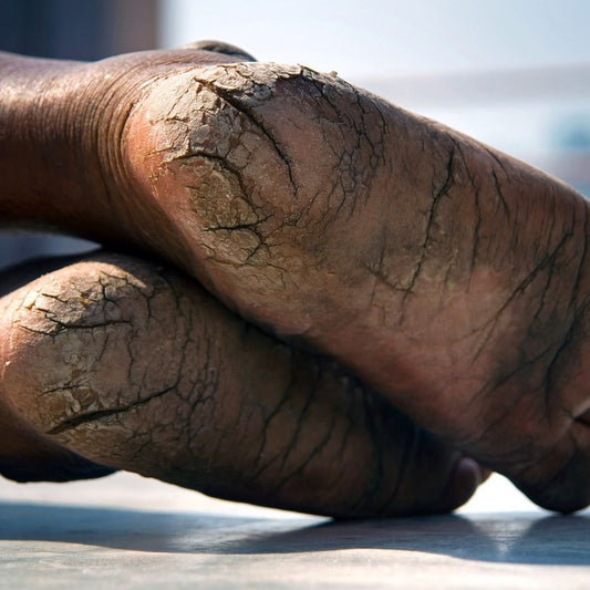 How to Heal Dry, Ashy, Cracked Heels Naturally (Especially in Winter)