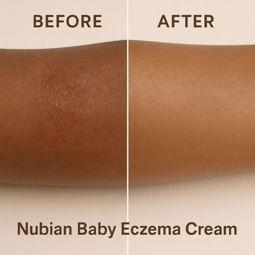 Nubian baby eczema cream | Natural Relief for Sensitive Melanated skin
